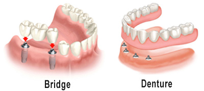 las Vegas Dental Implant Bridges & Dentures
