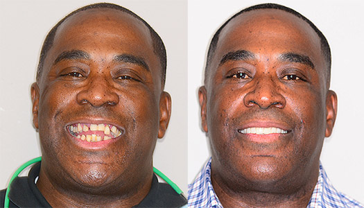 Dental Implants Las Vegfas