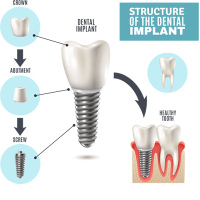 Dental Implants in Las vegas