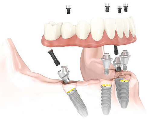 All On 4 Dental Implants Las Vegas