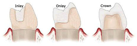 Dental Inlays & Onlays Las Vegas