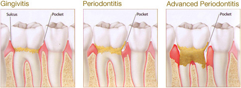 Periodontal Gum Treatment Las Vegas